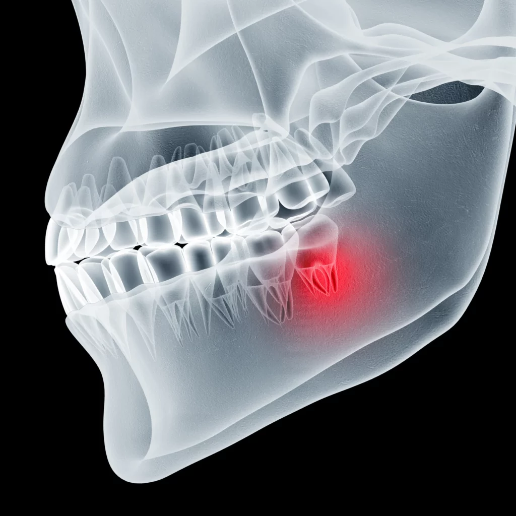 wisdom teeth removal in White House, TN