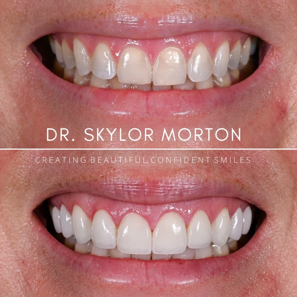 Before and after a smile makeover in Tennessee at White House Aesthetic & Implant Dentistry by Dr. Skylor Morton
