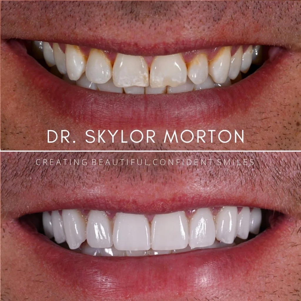 veneers before and after