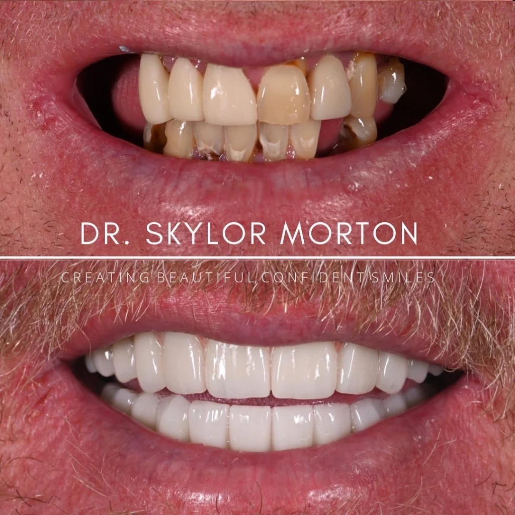 Before and after a smile makeover in Tennessee at White House Aesthetic & Implant Dentistry by Dr. Skylor Morton