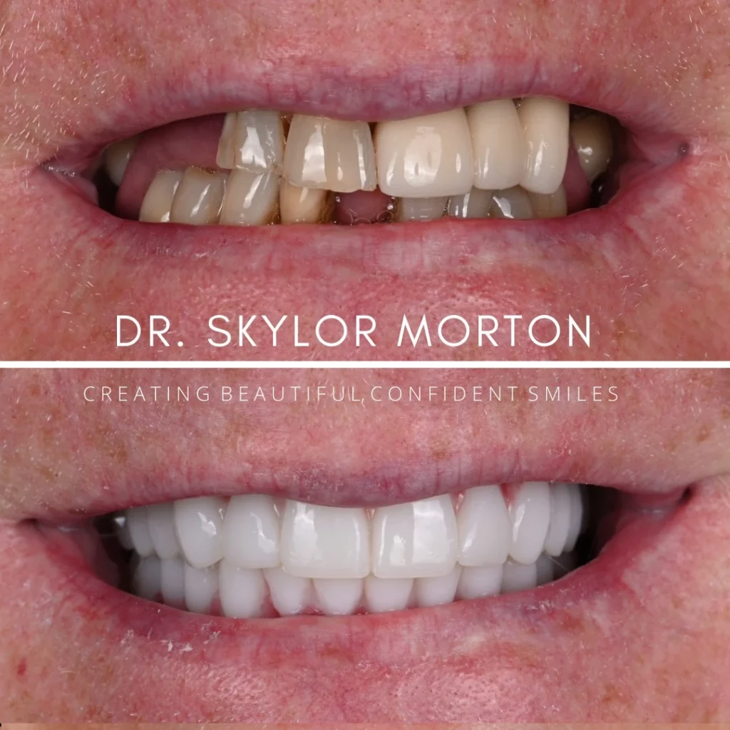 Before and after dental implants in White House, TN at White House Aesthetic & Implant Dentistry