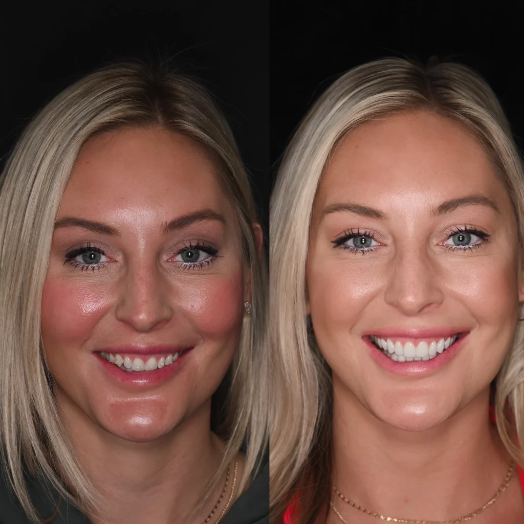 Before and after a smile makeover in Tennessee at White House Aesthetic & Implant Dentistry by Dr. Skylor Morton