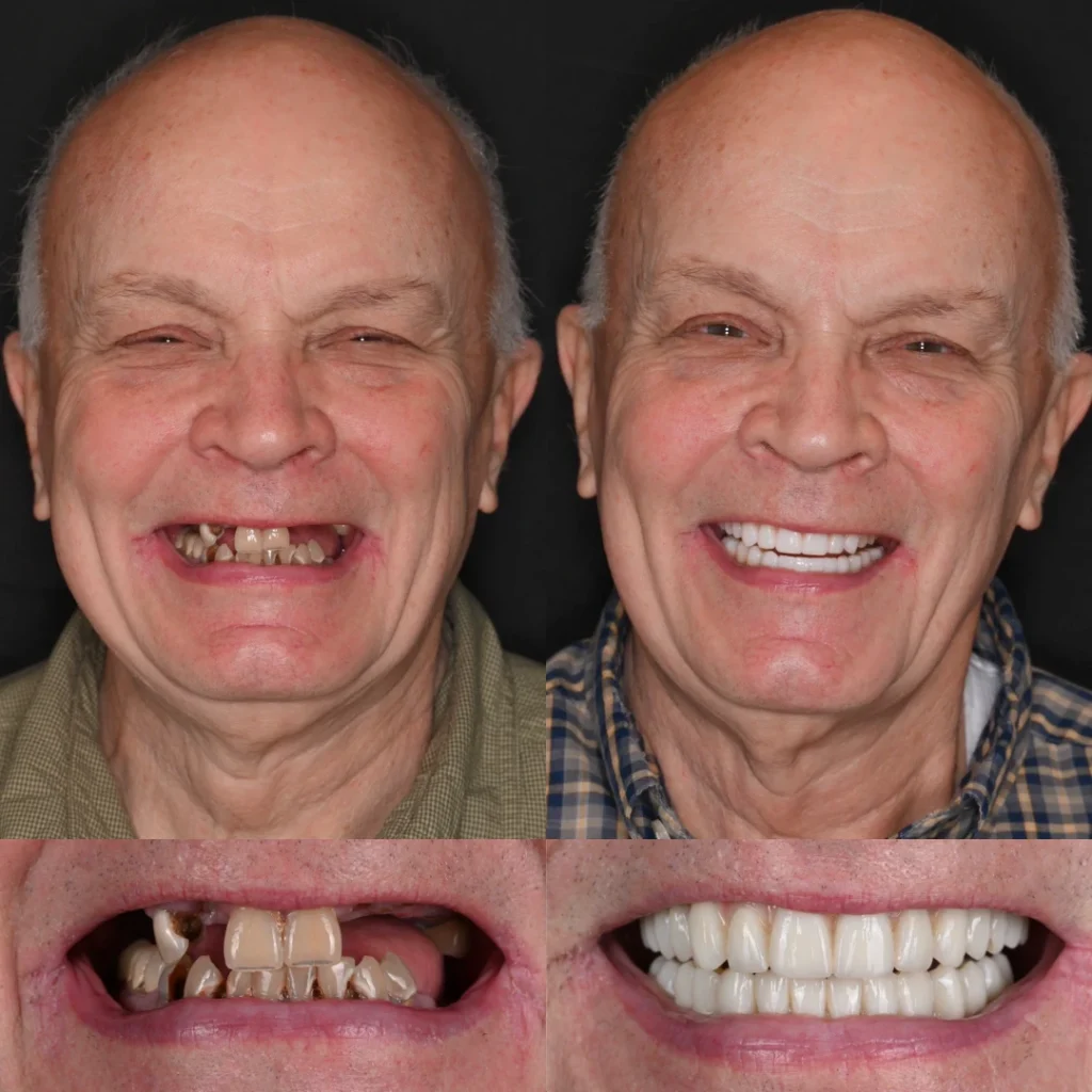 Before and after dental implants in White House, TN at White House Aesthetic & Implant Dentistry