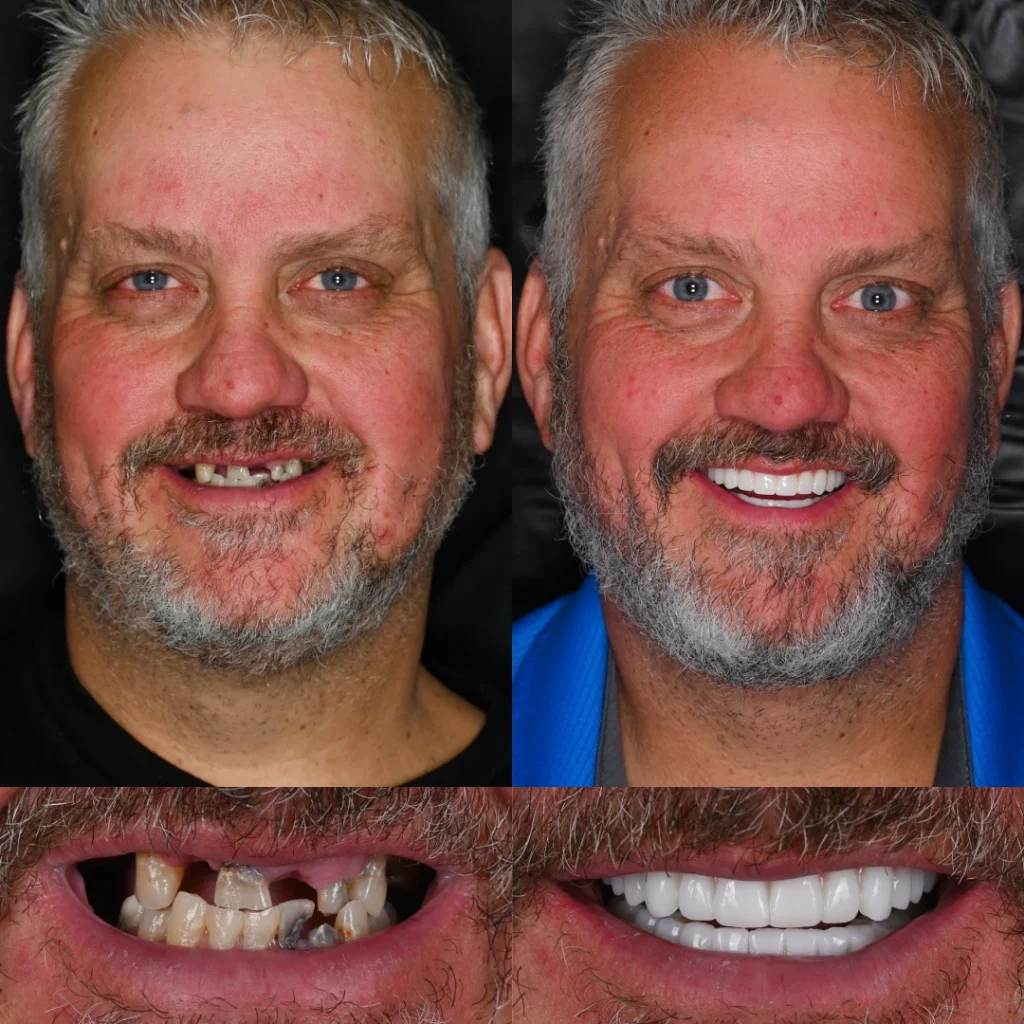 Before and after dental implants in White House, TN at White House Aesthetic & Implant Dentistry