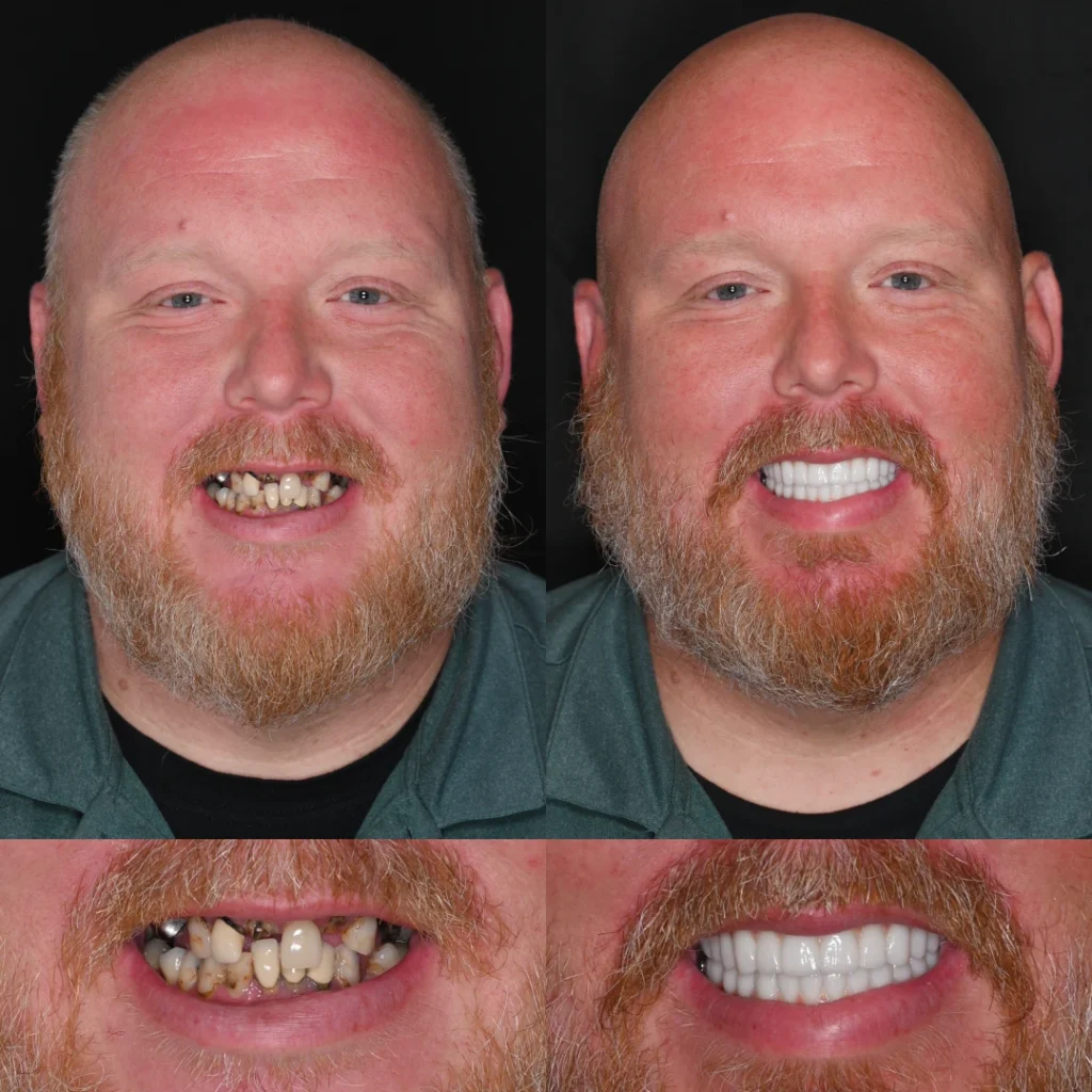 Before and after dental implants in White House, TN at White House Aesthetic & Implant Dentistry