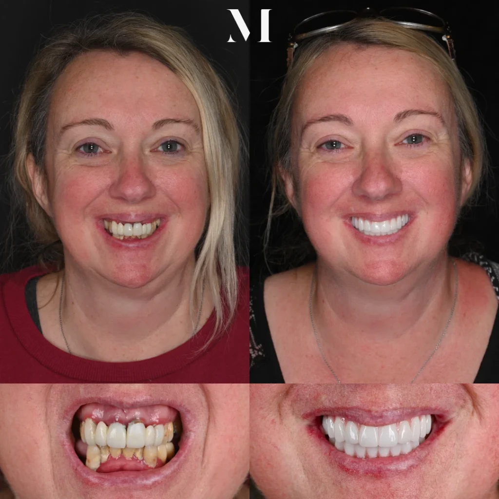 Before and after dental implants in White House, TN at White House Aesthetic & Implant Dentistry